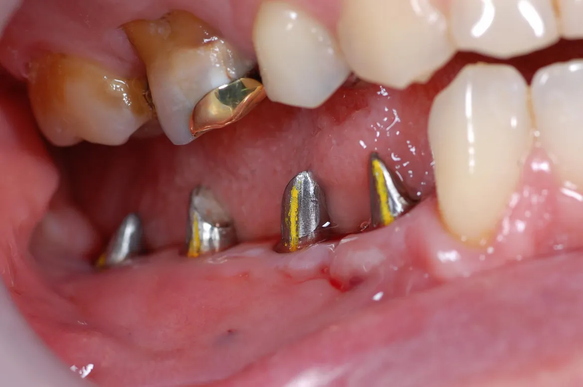 Pilares individualizados sobre implantes en sector inferior previo a la colocación de coronas