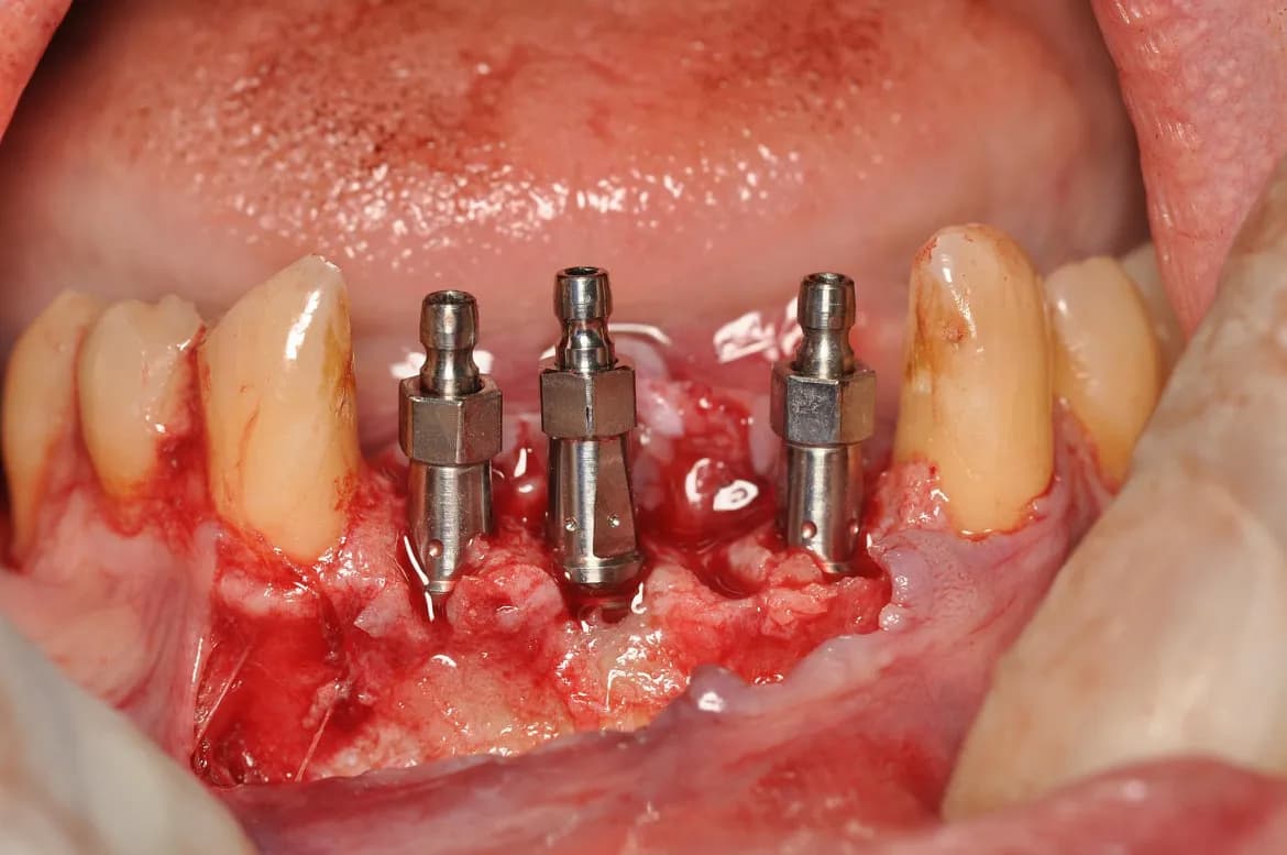 Acto quirúrgico de colocación de tres implantes en sector anterior inferior
