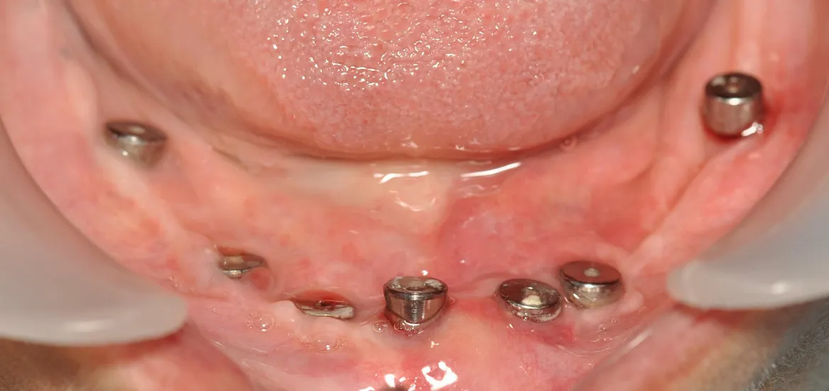 Vista oclusal de arcada inferior con tornillos de cicatrización sobre implantes en Ciudad Jardín Lomas del Palomar