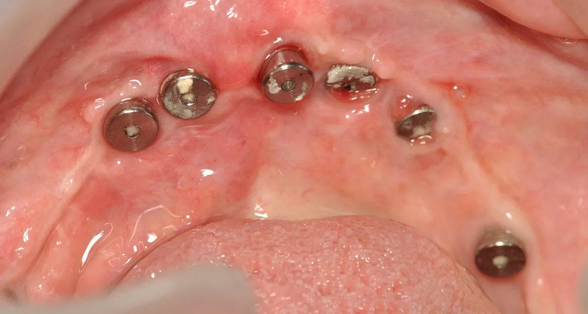 Caps de cicatrización en implantes oseointegrados de arcada superior